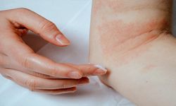 Egzama Hastalığı Nedir? Belirtileri Neler? Nasıl Geçer?