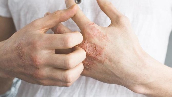 1556696134-79-intro-eczema-medium.jpg