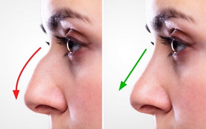 rhinoplasty-before-and-after-1080x675-1.jpg